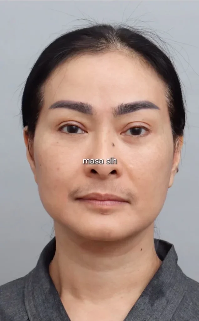 Wika Salim Jalani Perawatan Stem Cell di Korea, Hasilnya Membuatnya Terlihat Lebih Muda